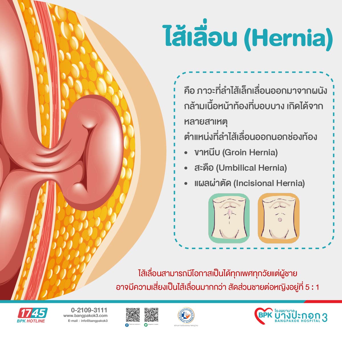 ทำความรู้จักกับโรคไส้เลื่อน, image size:1200x1200