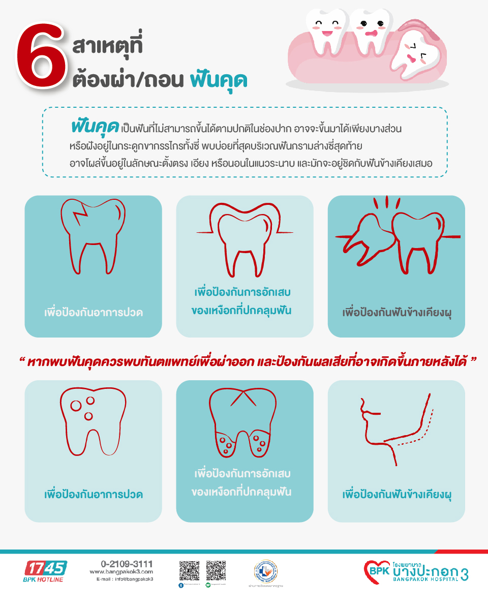 6 สาเหตุที่ต้องผ่า/ถอน ฟันคุด 6 สาเหตุที่ต้องผ่า/ถอน ฟันคุด